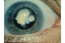 Katarakt Çeşitleri Nelerdir?