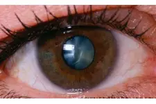 Katarakt Hastalığı Belirtileri ve Tedavisi