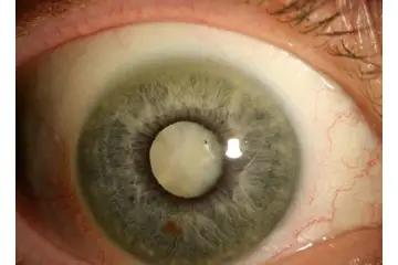 Katarakt Belirtileri ve Tedavisi