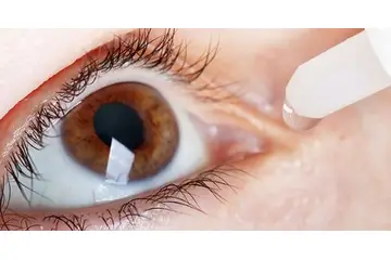 Katarakt Ameliyatı Sonrası Lens Kayması