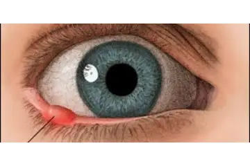 Katarakt Bitkisel Tedavi Yöntemleri Nelerdir?