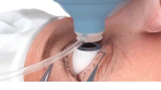 Katarakt Ameliyatı Riskleri ve Sonrası