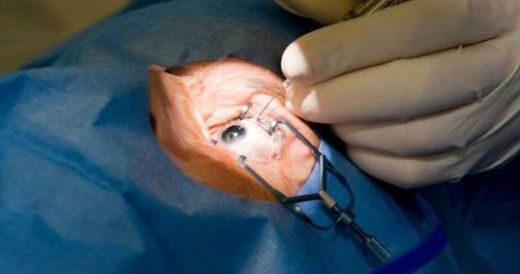 Katarakt Ameliyatı Sonrası Riskleri ve Sonrası